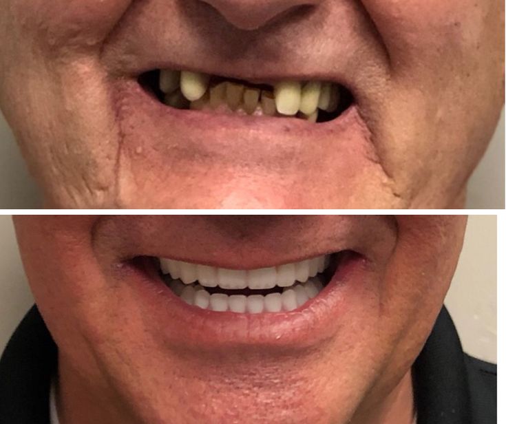 Kit com 2 Placas Dentais de Cerâmica Brancas – PARA TODAS ARCARIAS – Sorriso Perfeito com Praticidade