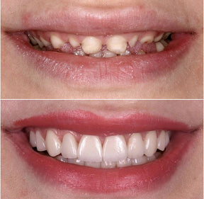 Kit com 2 Placas Dentais de Cerâmica Brancas – PARA TODAS ARCARIAS – Sorriso Perfeito com Praticidade