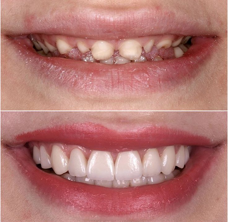 Kit com 2 Placas Dentais de Cerâmica Brancas – PARA TODAS ARCARIAS – Sorriso Perfeito com Praticidade